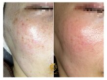 しらゆき 名古屋黒川/シミケア