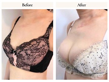 サロンドローヴ(Salon de LOAVE)/バストアップ症例