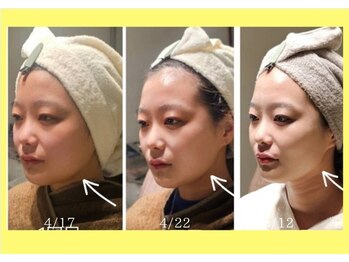 アン 銀座(ann)/レモンボトル3回