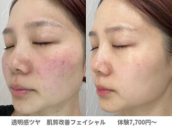 アンシャンテ 神戸元町店(Enchante)/肌質改善ピーリングフェイシャル