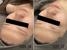 レイズ(RAISE)/当店人気No.1 水光ピーリング