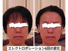 ピエルナ/エレクトロポレーションの変化