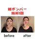 【最高峰エイジングケア】鍼ボンバー ★美容鍼＋核酸リポソームの美肌育ケア