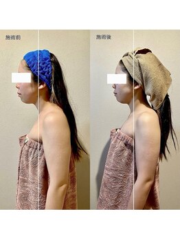 カルナ(CARNA)/猫背が一変！小顔コルギ