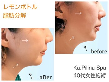 カピリナスパ(Ka.Pilina Spa)/レモンボトル before⇒after