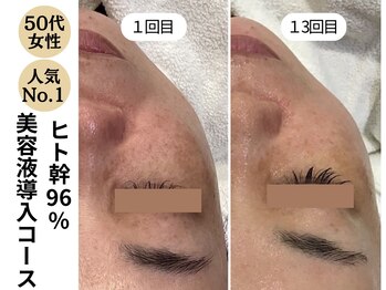 ディレイア ザ コスメ 有楽町マルイ店(direia the cosme)/月1～2回/くすみ［有楽町］