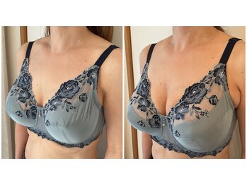 美バストアルファ(美bust α)/【バストアップ】症例