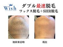 メンズ脱毛 ウィッシュ(Wish)/