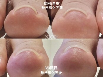 ニコプラス(NICO+)/巻き爪ケア