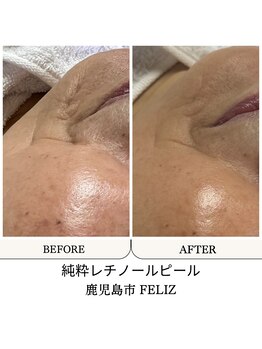 フェリス(FELIZ)/口元のゆるみを引き締める