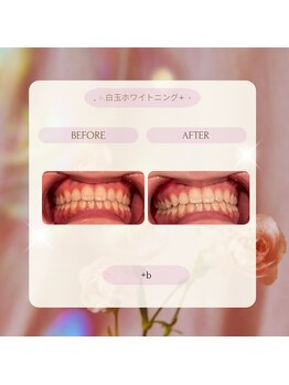 プラスビーセルフ(+b self)/ホワイトニングビフォーアフター