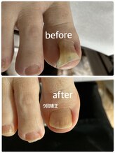 フロー(Froh)/ワイヤー矯正効果なく当店へ