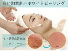 クリニカルエステ/イーズ パークプレイス大分店/イーズのホワイトピーリング