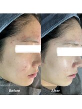 モカ 天王寺店(MOKA)/剥離ハーブピーリングニキビケア