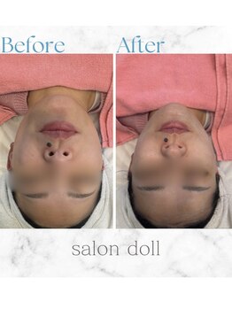 サロンドール(Salon doll)/最新マイクロ波オンリフト導入店