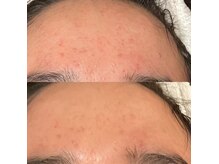 ウェリナベル(WelinaBelle)の雰囲気（韓国で話題の最新韓国美容！ダクトピ-ルでニキビ凹凸肌改善！）