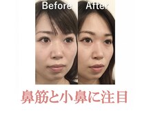 ラプリ 仙台店(Raplit stella)/隆鼻矯正+輪郭40分 10回