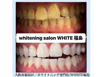ホワイトニングサロン ホワイト(WHITE)/セルフホワイトニング/大阪/福島