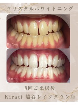 キラット 越谷レイクタウン店(Kiratt)/ビフォーアフター　3