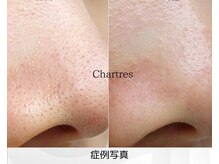 シャルトルズ 西宮北口店の雰囲気（毛穴のふち汚れも除去◎結果を重視したご提案/黒ずみ/開きに特化）