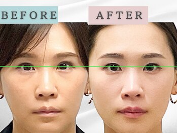 エルシンメトリー矯正院(ailesシンメトリー矯正院)/before＆after　ailes式小顔矯正