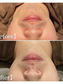 フォルチェ 春日(Folche)/メンズ脱毛はお電話予約で♪