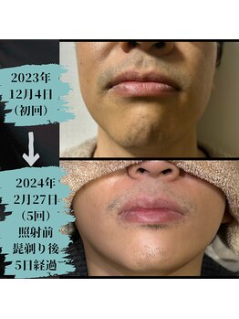 ルーチェ/【ヒゲ脱毛】3回目でも実感