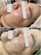 ブライトリー(Brightly)/最新光エステでシミ改善！