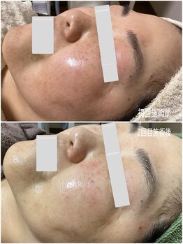 ブライトリー(Brightly)/最新光エステでシミ改善!