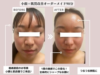 リッツ(RITZ)/【小顔矯正＋肌質改善】症例写真