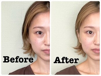 つつじが丘整骨院鍼灸マッサージ院/美容鍼　before after