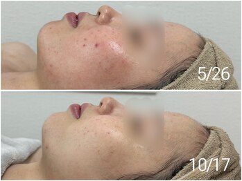 アンリミット 原宿竹下通り店(Une limit)/【乳酸菌ピーリング】