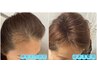 Neｗ！髪のボリュームにお悩みの方◎臍帯幹細胞！初育毛促進¥55000→¥25800