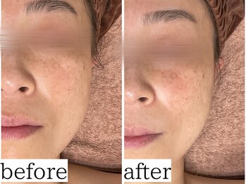 アンドナップ(nap)/肌質改善