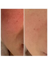 アリュール(Allule)/赤みもおさまります