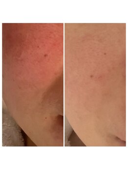 アリュール(Allule)/赤みもおさまります