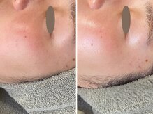 カプリス(CAPRiCE)/BBLフェイシャル