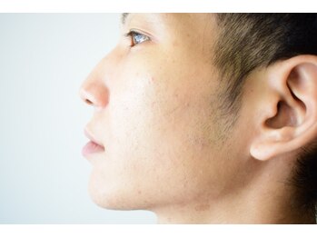 ヒビキノ バイ ヒビハンビューティー(hibikino by Hibihan Beauty)/大人気のメンズのひげ脱毛