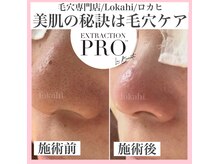 ロカヒ(Lokahi)の雰囲気（毛穴でお悩みの方もたくさんご来店頂いております！）