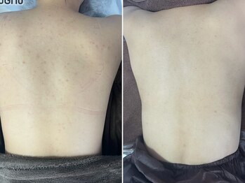 エミルカ 神戸三宮(EMILUCA)/背中ニキビケアに♪