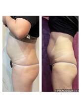 ビプラス(VIPLAS)/サーモシェイプ（お腹）