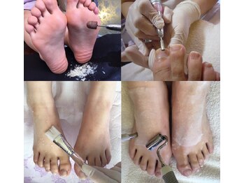 ビサンテ サロン/角質ケア&足表甲+美容液導入set