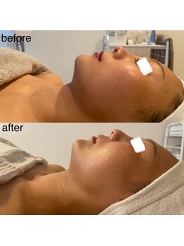 エミナル(EMINALu)/リバウンドレスな小顔矯正