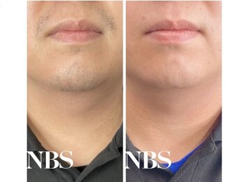 ミュースタイル(mieux-style)/THR脱毛