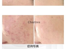 シャルトルズ 西宮北口店の雰囲気（細かい洗浄工程がウリ◎専門店だからこそ！理想の【毛穴レス】へ）