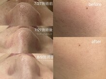 自己流でなかなか改善しない黒ずみ、開き毛穴もお任せください