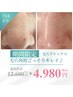 《期間限定》黒ずみ/いちご鼻/角栓 はプロにお任せ！¥12.600→¥4.980
