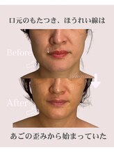 アンジェリカ(Angelica)/口元もたつき、片側が濃い法令線