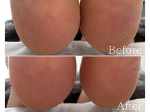 カシェット 広島店(Cachette)/40代女性☆足裏角質ケア90分