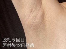 ボーテ ドゥ ランジュ(BEAUTE DE L’ANGE.)/◆わき脱毛◆